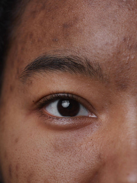 Key Factors That Aid In Reducing Hyperpigmentation