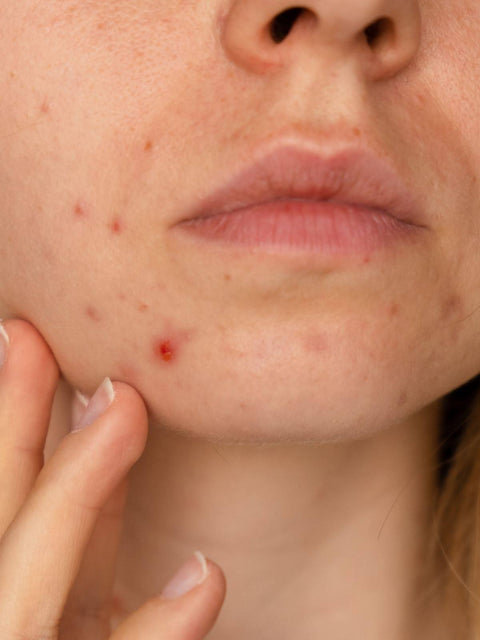 Why Acne Often Leaves Behind Unwanted Dark Marks